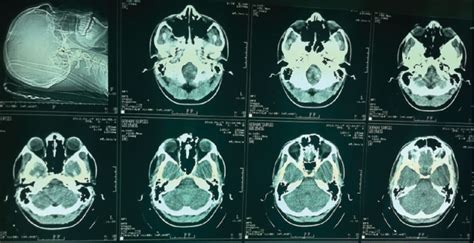 The Head Computed Tomography Images Of The Patient Download