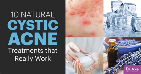10 Natural Cystic Acne Treatments That Really Work Cystic Acne