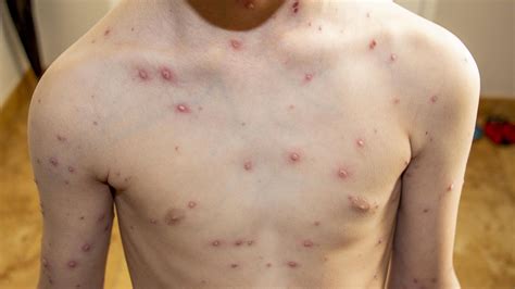 Chickenpox A Complete Guide To Symptoms Spread And More
