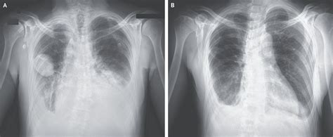 Phantom Tumor Of The Lung Medizzy