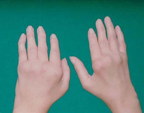 Rheumatische Hand Ursachen Diagnose Therapien Orthinform
