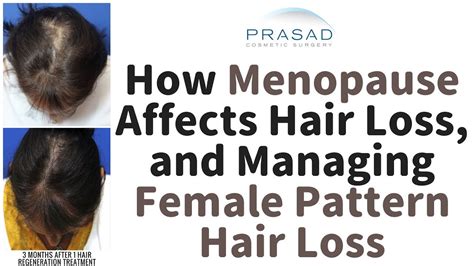How Pattern Hair Loss Increases In Women Over 50 And How Menopause Can