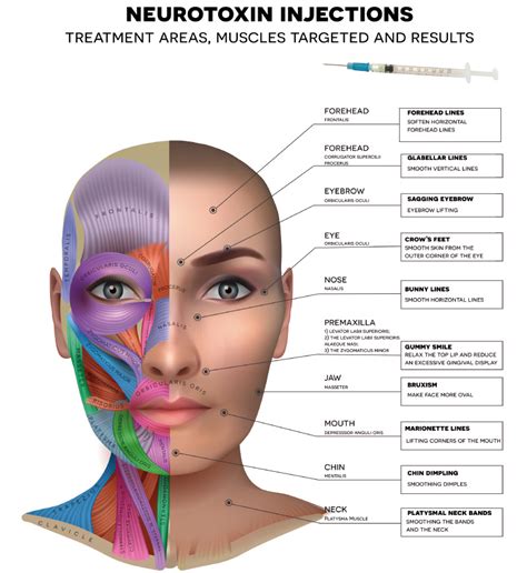 Face Map For Botox Injections