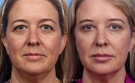 Is probably good to flag now. Filler Correction Photos • Rejuvent Medical Spa Scottsdale