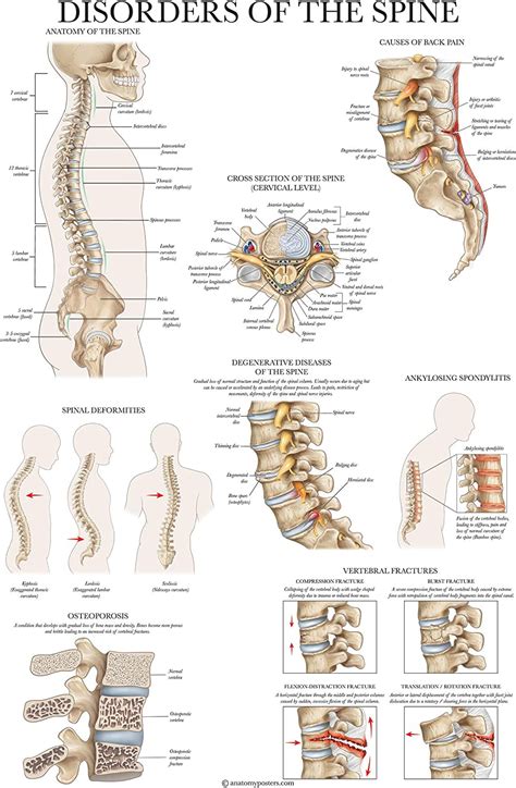Chart Anatomical Disorders Spinal Laminated Poster Anatomy Spine The