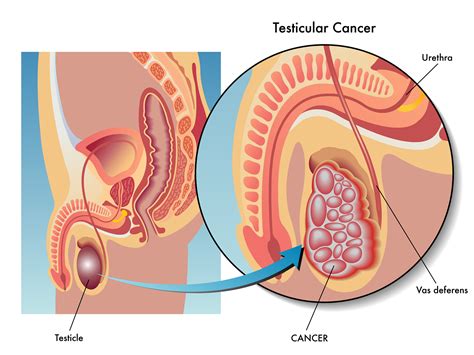 germ cell tumors and testicular cancer net health book