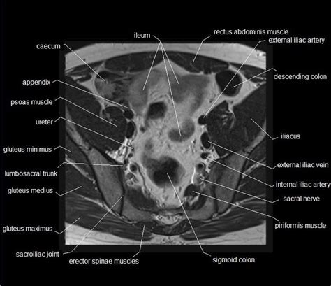 More images for back muscles anatomy ct » MRI pelvis anatomy | free male pelvis axial anatomy ...