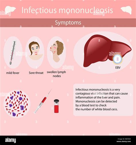 Symptoms Of Infectious Mononucleosis Vector Illustration Infographics