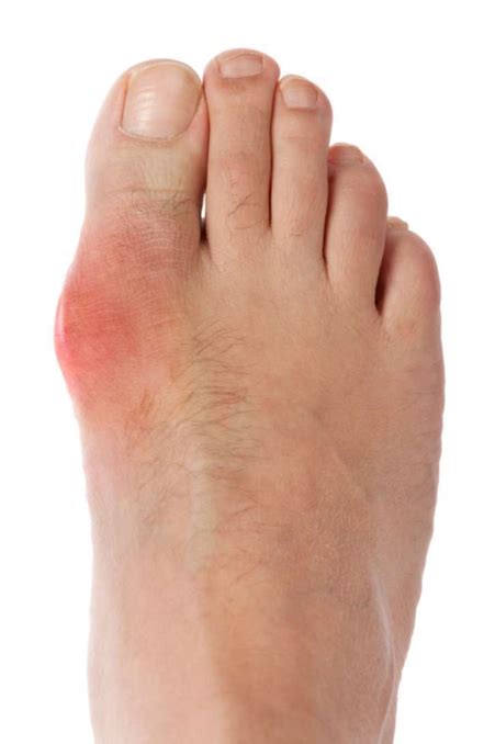 Gout Everything You Should Know Purmedica Nutritional Science