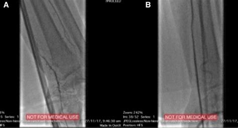 Angiogram Of Left Radial Artery At The Level Of The Wrist In The