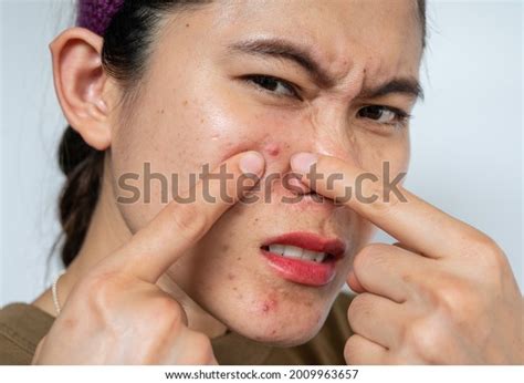 Asian Woman Pointing Acne Inflamed On Stock Photo Edit Now 2009963657