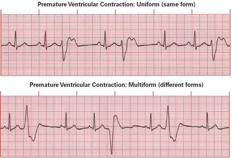 Multifocal Premature Ventricular Contractions