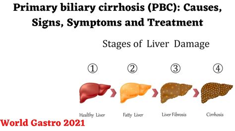 Primary Biliary Cirrhosis Pbc Causes Signs Symptoms And Treatment
