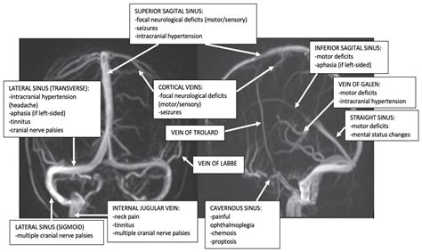 Diagnosis Of Cerebral Veins And Dural Sinuses Thrombosis Encyclopedia