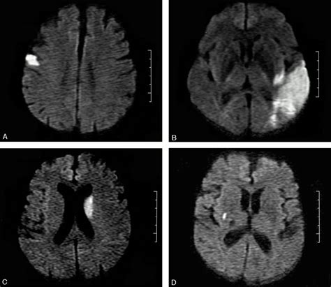 Contribution Of Diffusion Weighted Imaging In Determination Of Stroke