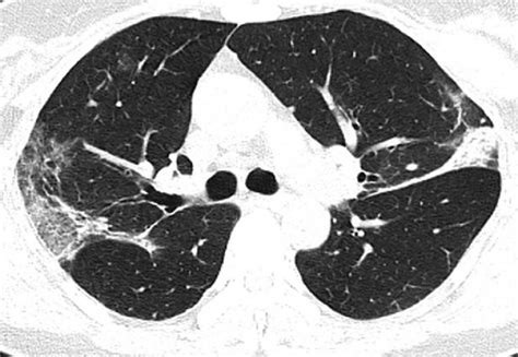 Ct Scans And X Rays Display The Damage To The Lungs Of Covid 19 Patients