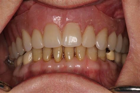 Immediate Denture After Removal Of All Upper Teeth Vdsc