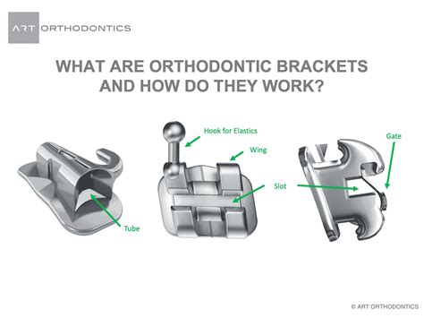 Orthodontic Brackets Braces How Do They Work Art Orthodontics Davie Fl Vlr Eng Br