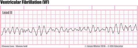 Ecg Educator Blog Ventricular Fibrillation Vf