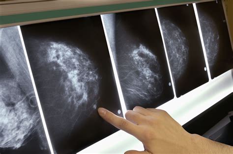 Important Facts About Breast Cancer Tumors