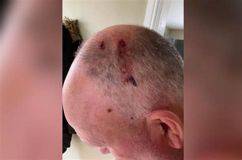 Dad Attacked By Monster Seagull Thats Terrorised Street For Weeks