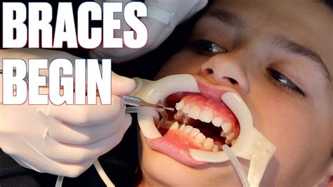 Getting Braces For The First Time How To Shorten Time With Braces By