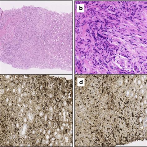 Hematoxylin And Eosin Stain Demonstrating Obliterative Phlebitis In A