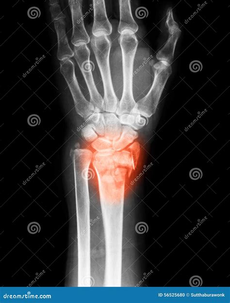 X Ray Image Of Wrist Joint Pa View Stock Photo Image Of Care