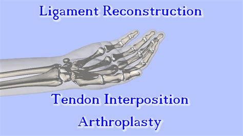 The Anchovy Procedure For Thumb Basal Joint Arthritis Youtube