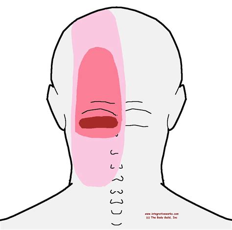 Head Pain Back Of Head The Complete Headache Chart