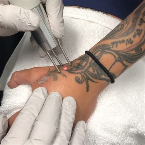 Things You Should Know About Tattoo Removal Tattoo Cares