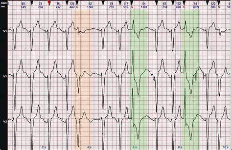 心电图图例分析：完全性左束支阻滞、双源性室性早搏 - 爱爱医医学网