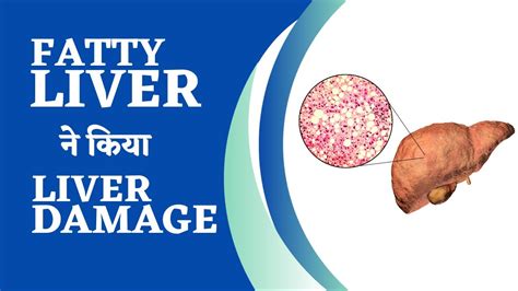 Fatty Liver Liver Damage Explained Reasons And Treatment