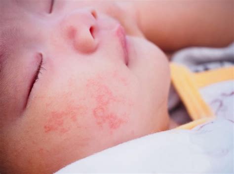 The Great Debate To Use Or Not To Use Steroid In Your Childs Eczema