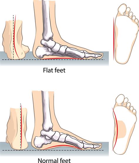 Flat Feet Treatment With Implant Procedure At Fv Hospital Fv Hospital