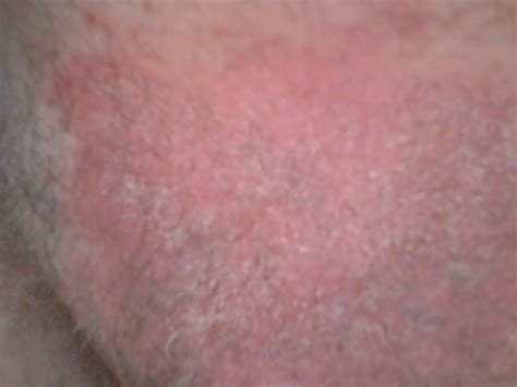 The skin rash in inverse psoriasis is bright red, shiny and smooth to the touch. What is causing this rash in my groin area (see photo)? It