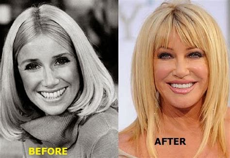 Suzanne Somers Plastic Surgery Before And After Plastic Surgery Photos