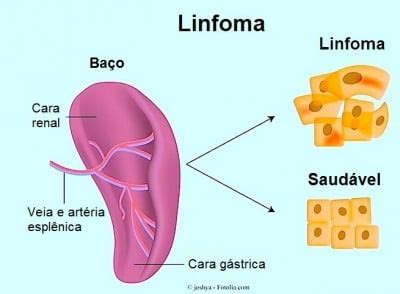 Sintomas não, os sintomas são os mesmos independente se for lh ou lnh! Linfoma de Hodgkin e não-hodgkin, sintomas, tratamento e estadiamento