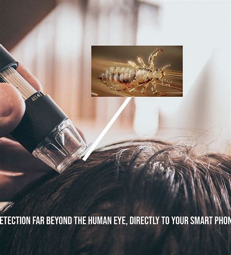 Lice Detection | Lice Detective | Head lice nits, Louse ...