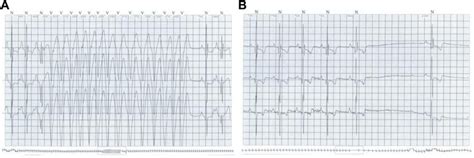 Holter Monitor Findings A Nonsustained Ventricular Tachycardia B