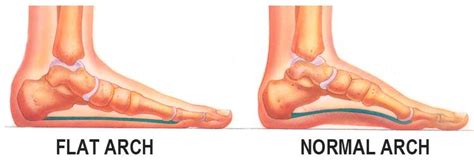 A flatfoot ailment should be addressed. Health Risks of Flat Feet and How You Can Prevent It