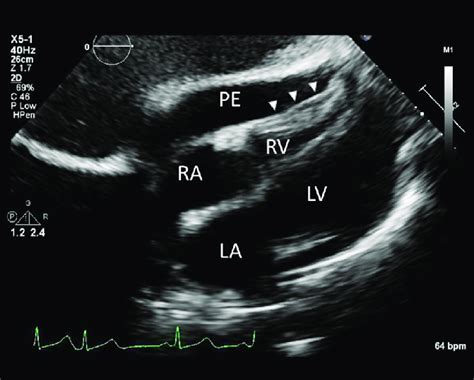 Echocardiogram Subcostal View Demonstrating Large Pericardial Effusion
