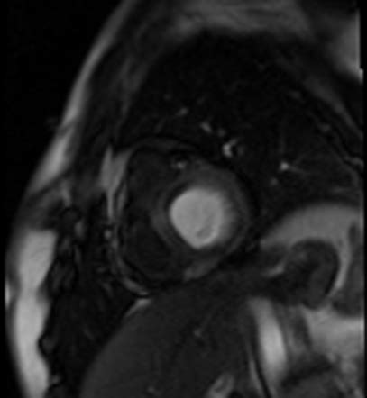 Acute Anteroseptal Myocardial Infarction Image Radiopaedia Org