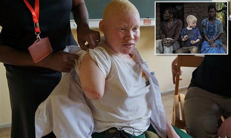 Pin On Albino Man Woman