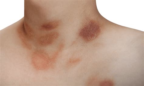 14 Rashes You Need To Know Common Dermatologic Diagnoses