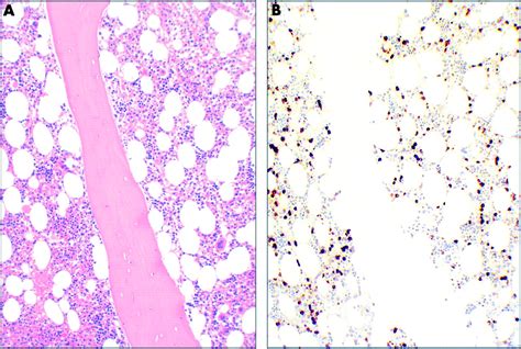 Bone Marrow Immunohistology Of Plasma Cell Neoplasms Journal Of