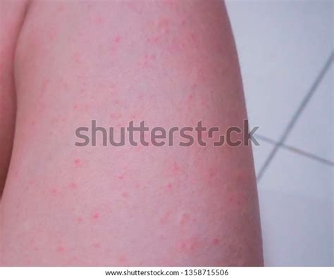 Skin Leg Itching Rashred Spots On Stock Photo 1358715506 Shutterstock