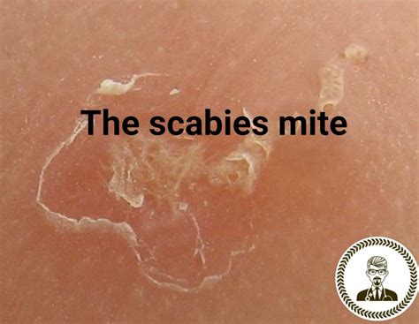 What Does Scabies Look Like Images Education Nigeria