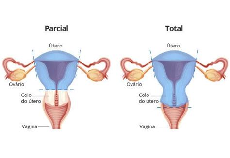 Histerectomia Cirurgia De Retirada Do Tero
