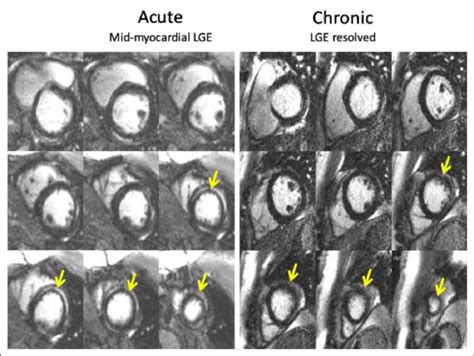 Late Gadolinium Enhancement Lge Images In The Acute And Chronic
